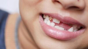 É preciso cuidar dos dentes de leite? Saiba sobre