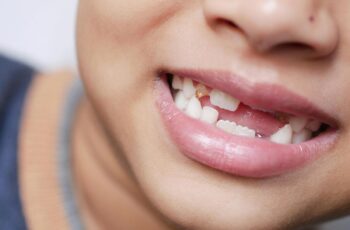 É preciso cuidar dos dentes de leite? Saiba sobre
